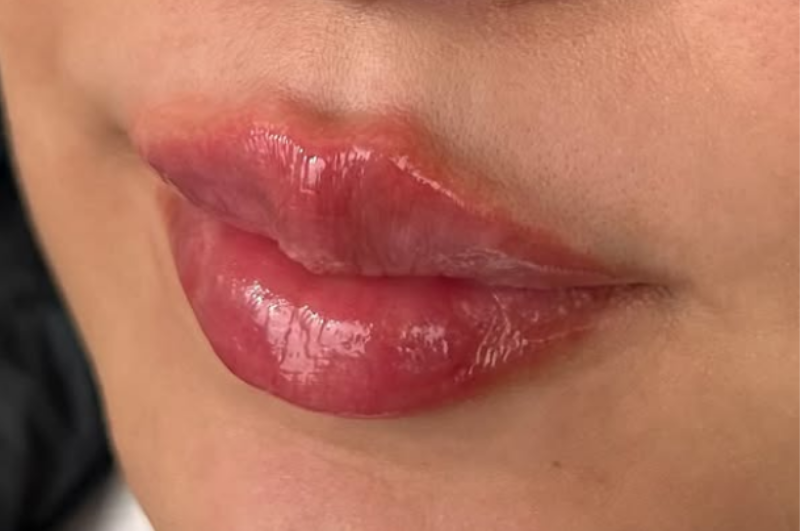 Lips that have received medical aesthetics treatment at Modern Vital Aesthetics.